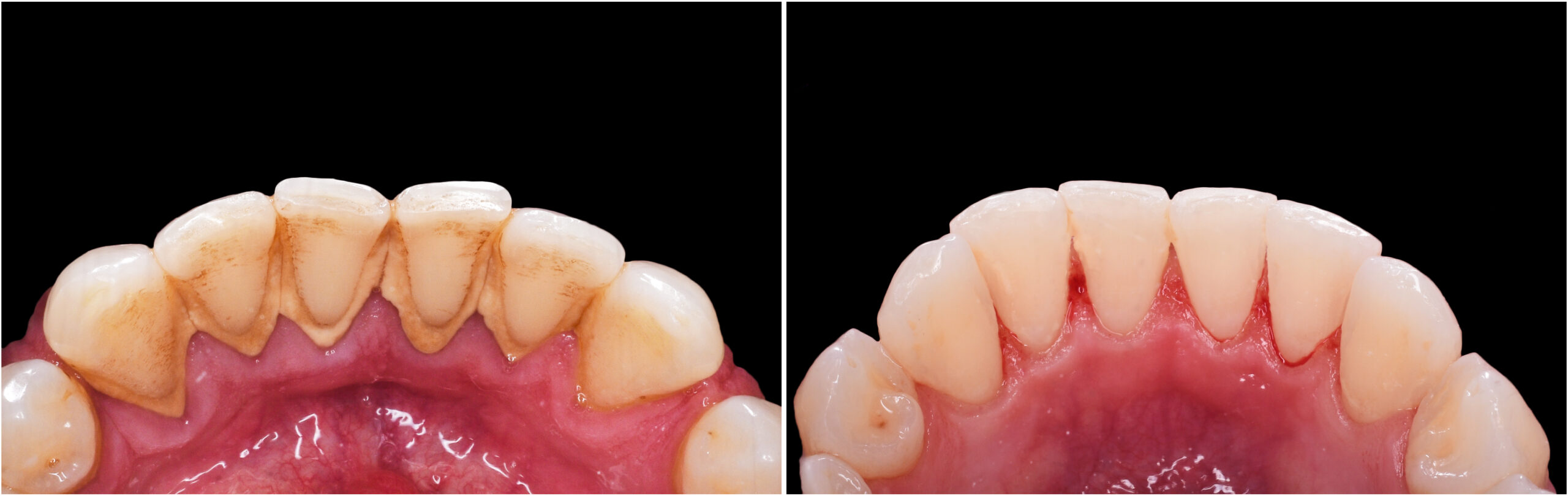 Teeth,Cleaning,And,Whitening,Before,And,After,Picture